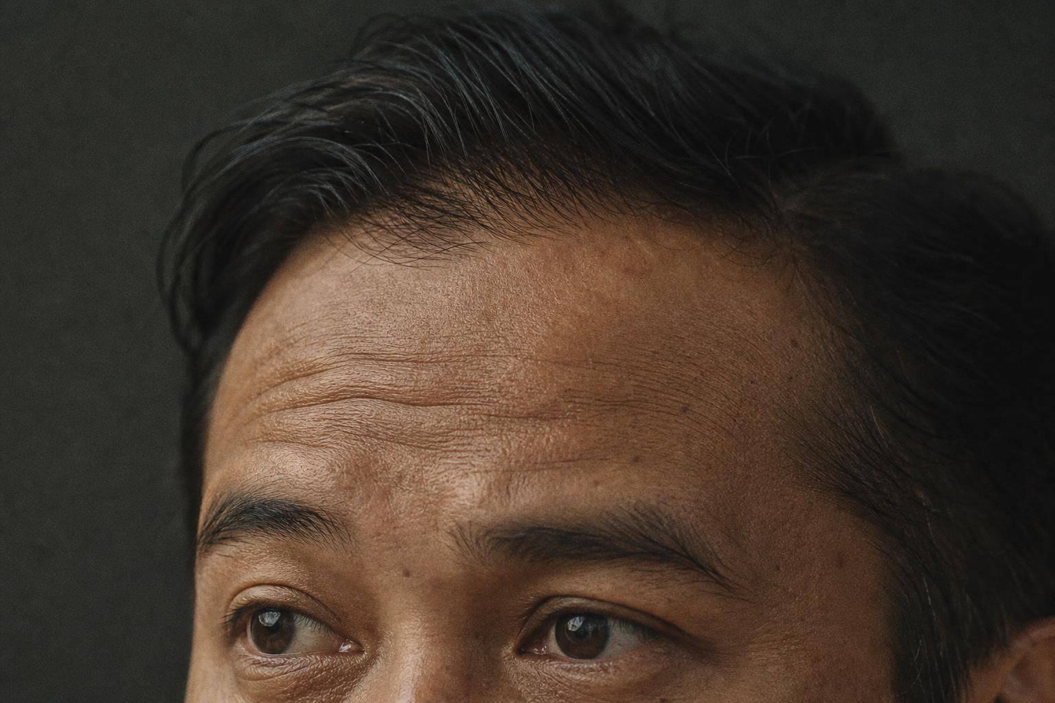 Illustrative example of Forehead lines on the male face
