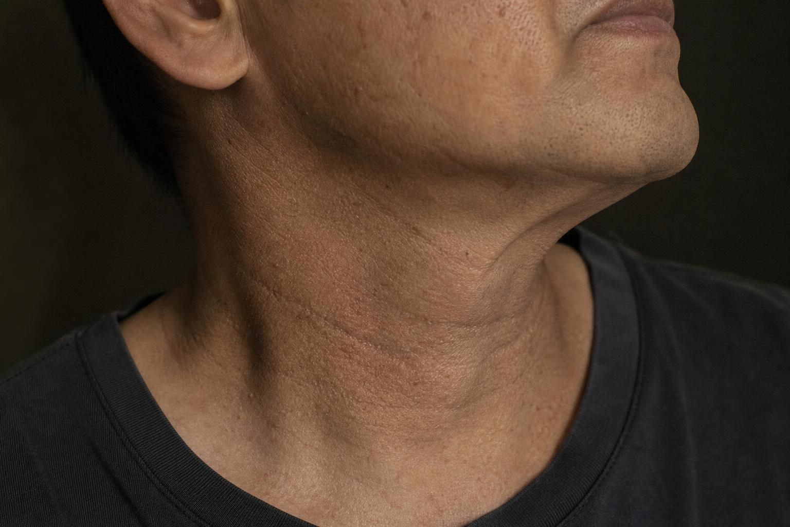 Illustrative example of Neck lines on the male face